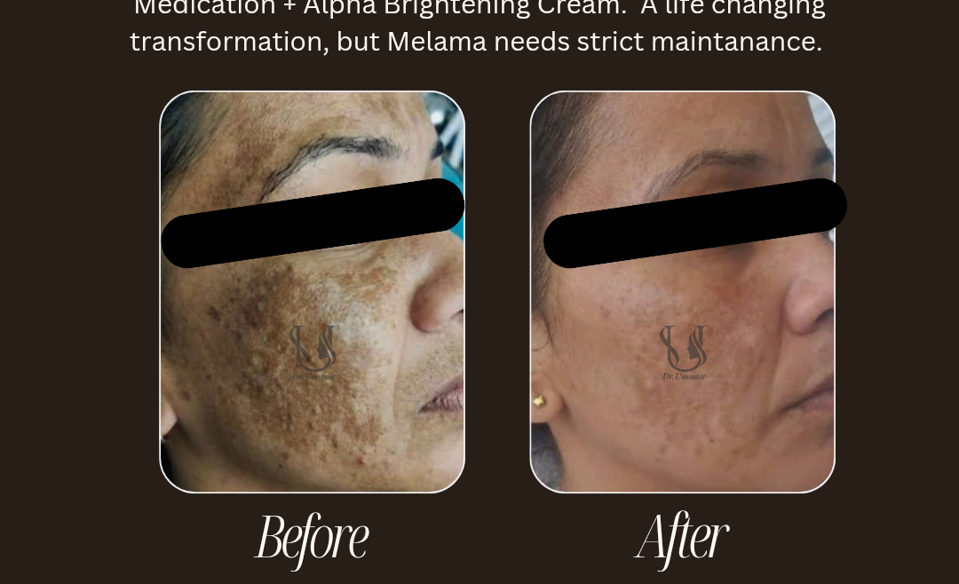 Melasma