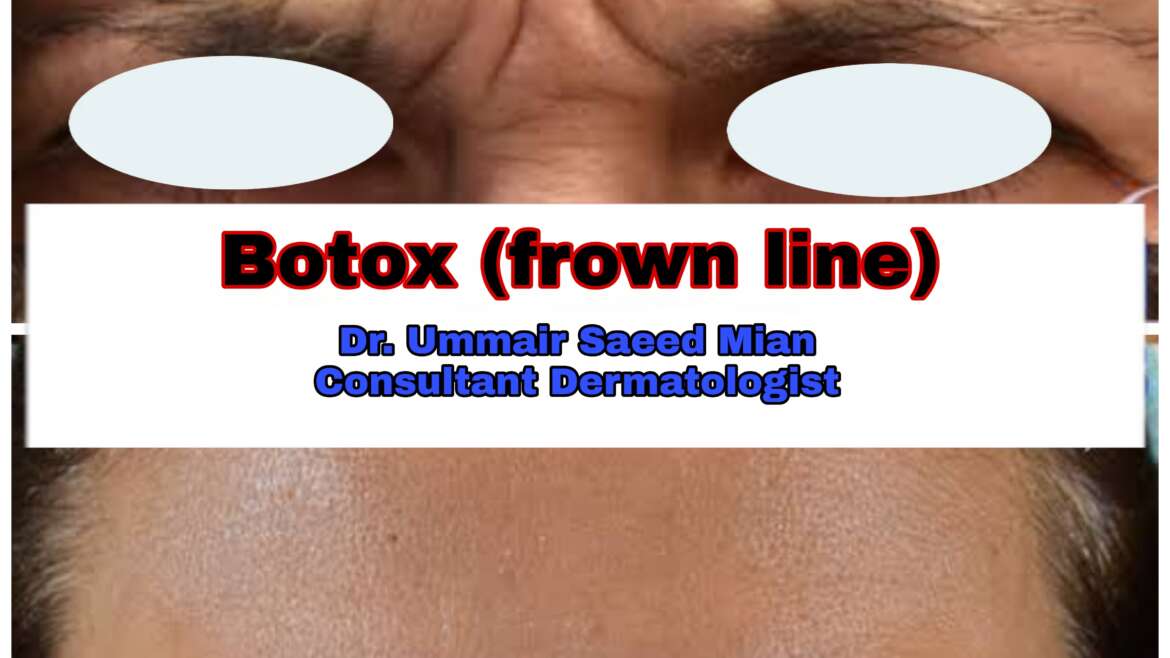 BOTOX