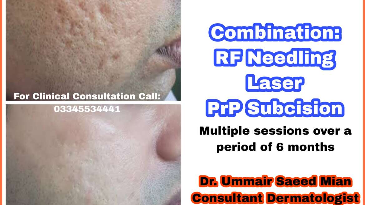 Acne scarring