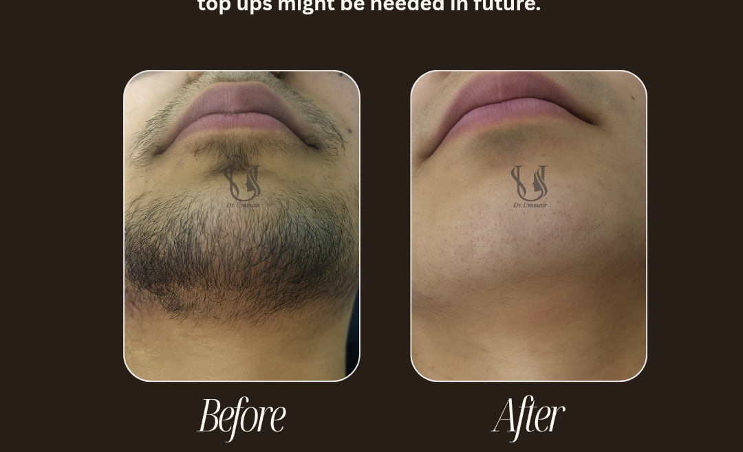 Multi-Wave Laser Hair Removal