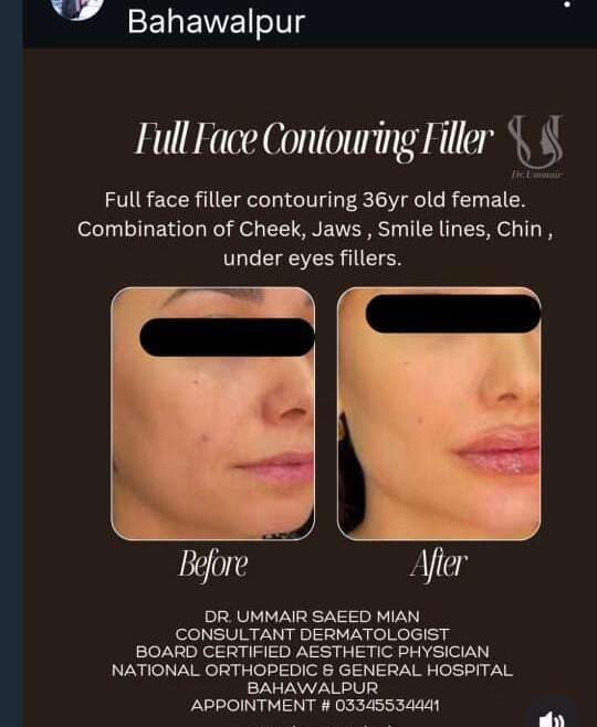 Fillers Contouring